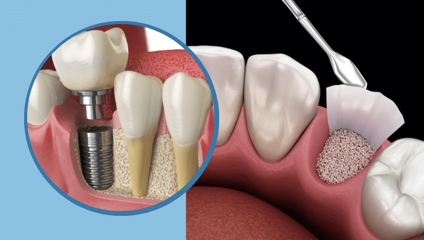 How Bone Grafting Supports Your Dental Implants