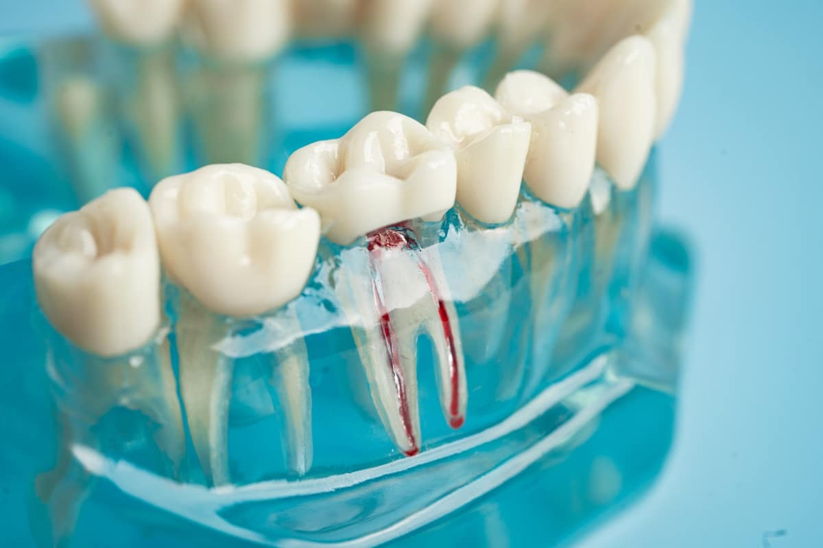 Root Canal Treatment In Butler